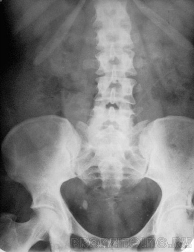 Обзорная рентгенограмма мочевой системы. Камень нижней трети правого мочеточника